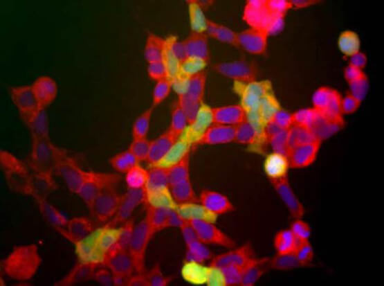 Immunofluorescence Microscopy - Anti-NSE (Neuron specific enolase) antibody.