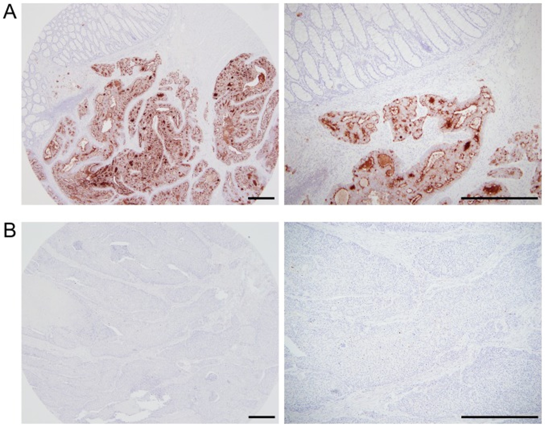 Immunohistochemistry using Mesothelin