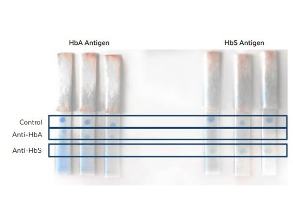 Lateral Flow Results of Anti-HbS Antibody