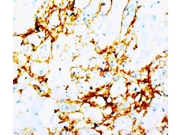 Immunohistochemistry of Anti-Tenascin