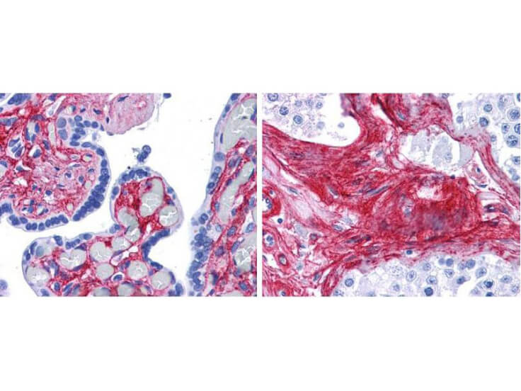 Rockland anti collagen VI antibody (600-401-108 Lot 26009, 1:400 45 min RT) showed strong staining in FFPE sections of human placenta (Left) with red staining of stromal and extracellular spaces, and in testis (Right) with staining of extracellular spaces between seminiferous tubules). Slides were steamed in 0.01 M sodium citrate buffer, pH 6.0 at 99-100°C - 20 minutes for antigen retrieval. Images provided courtesy of LifeSpan Biosciences, Seattle, WA