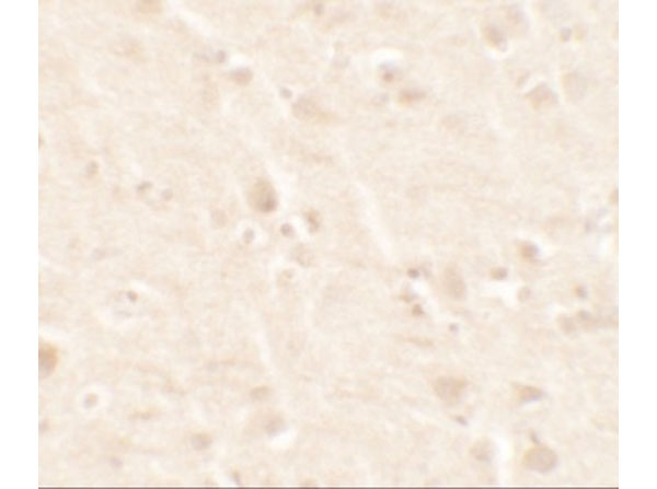 Immunohistochemistry of Beta 2 Microglobulin